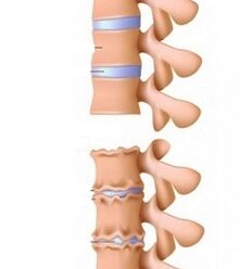 Etapas de rampas de osteocondrosis del cuello