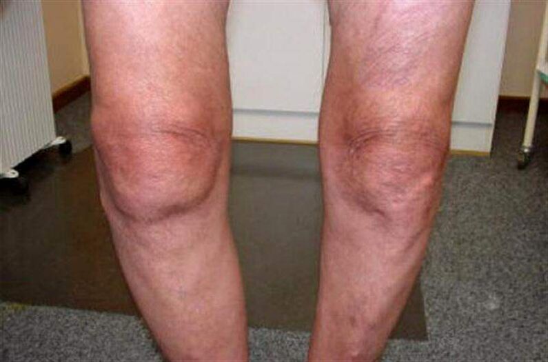 rodilla hinchada por artritis