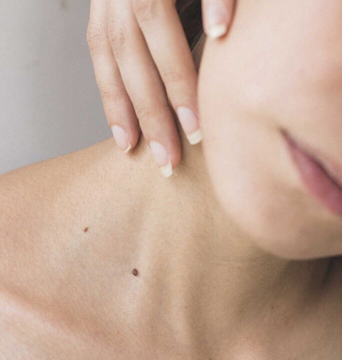 La rigidez en el cuello es uno de los síntomas de la etapa inicial de la osteocondrosis de la columna cervical.