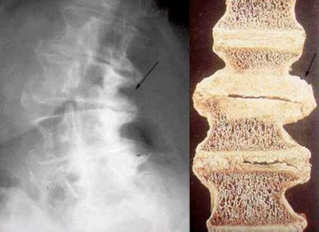 Daño a las vértebras en la osteocondrosis torácica.