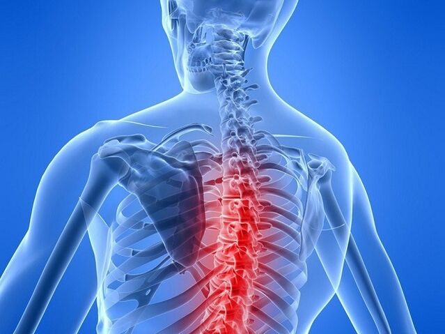 osteocondrosis de la columna torácica