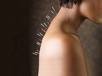 La reflexoterapia es un método eficaz para tratar la osteocondrosis cervical.