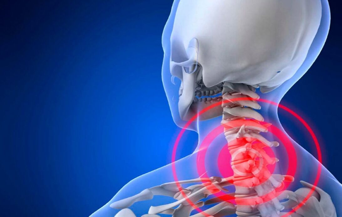osteocondrosis de la columna cervical